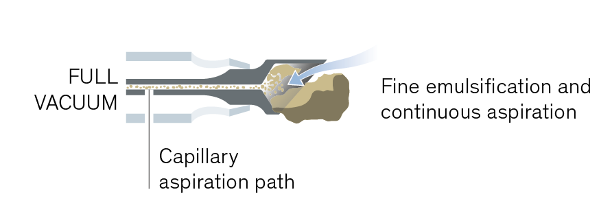 Diagram of easyPhaco principle showing full vacuum, capillary aspiration path, and fine emulsification with continuous aspiration