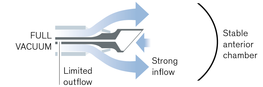 EasyPhaco graphic showing full vacuum with limited outflow and strong inflow, supporting a stable anterior chamber