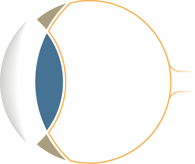 Simplified cross-sectional diagram of the eye highlighting the anterior chamber and cataract application field for phaco surgery